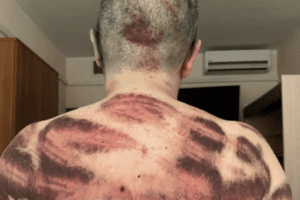 Cecenia, le nuove immagini di Elena Milashina: 14 fratture e schiena massacrata dalle frustate | Russia: “Danni minori” | Arriva l’omaggio coraggioso degli studenti russi